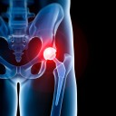 Total Hip Replacement