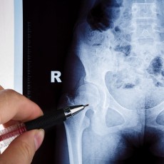 Pelvis X-ray (4 views)