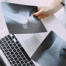 Knee X-Ray (2 views)