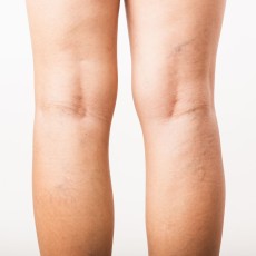 Endovenous Laser Varicose Veins (both legs)
