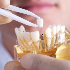 Titanium Dental Implant with Zirconia Crown