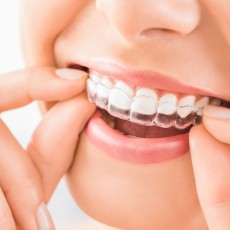 Angel Aligner Select 30 Invisible Orthodontics (both arches)