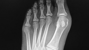 Recovery after Bunion surgery