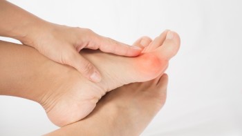 When do you need bunion surgery?