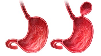 Hiatal Hernia: what it is, causes, symptoms and treatments