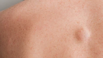 Differences between lipomas and sebaceous cysts
