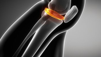 Types of meniscal injuries: Lateral meniscus injury