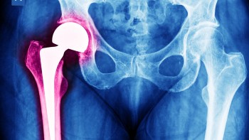 Hip Replacement Infection: Causes, Symptoms and Treatment
