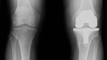 Recovery after total knee replacement surgery. Hospital stay