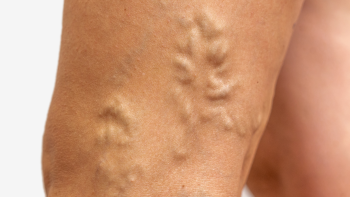 Varicose veins: complications and symptoms