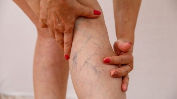 Varicose Veins: what they are, causes, symptoms and treatments