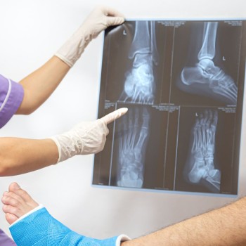 Foot X-ray (4 views)