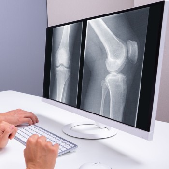 Knee X-Ray (4 views)
