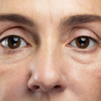 Upper and Lower Eyelid Surgery (blepharoplasty)