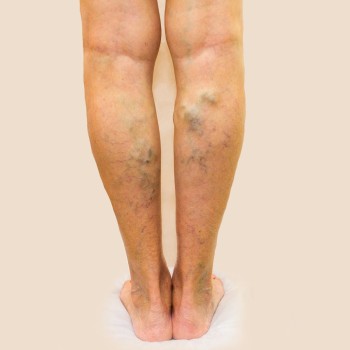 Radiofrequency Ablation for Varicose Veins (one leg)