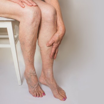 Radiofrequency Ablation for Varicose Veins (both legs)