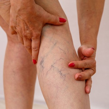 Varicose vein surgery by stripping or saphenectomy