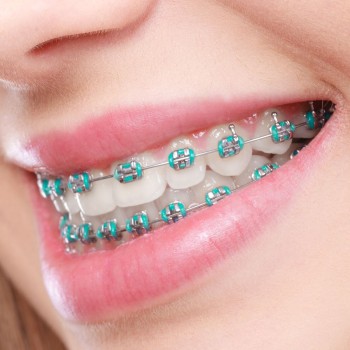 Orthodontic Treatment with Metal Brackets (both arches)