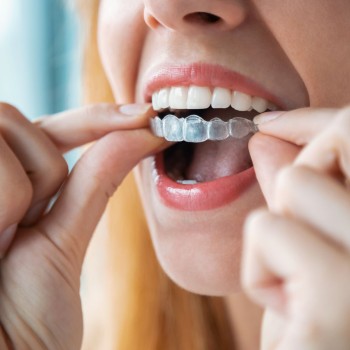 Angel Aligner Select 10 Invisible Orthodontics (both arches)