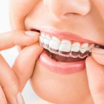 Angel Aligner Select 30 Invisible Orthodontics (both arches)