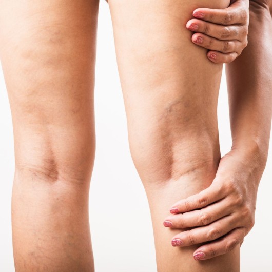 Endovenous Laser Treatment for Varicose Veins (one leg)