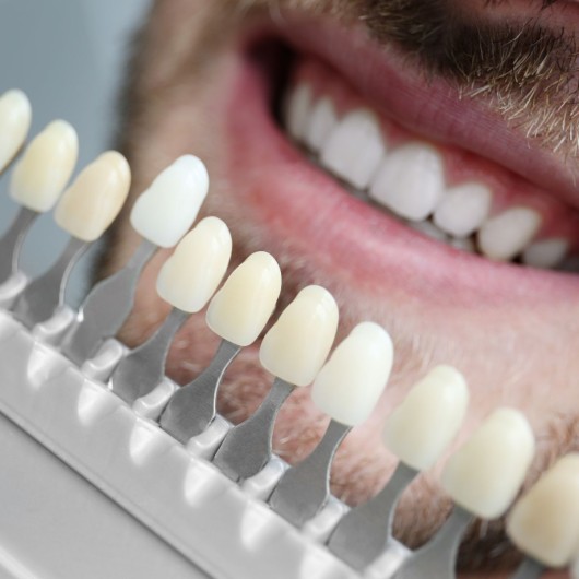 Dental Veneers (per tooth)