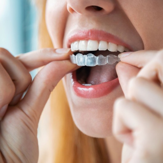 Angel Aligner Select 10 Invisible Orthodontics (both arches)