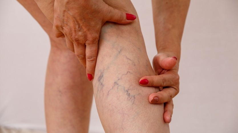 Varicose veins