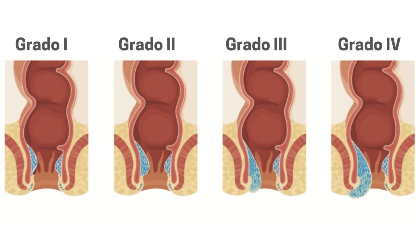 Hemorrhoids Types of Grades