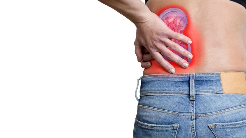 Laser lithotripsy for kidney stones