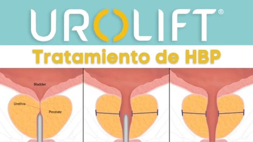 Urolift prostate surgery