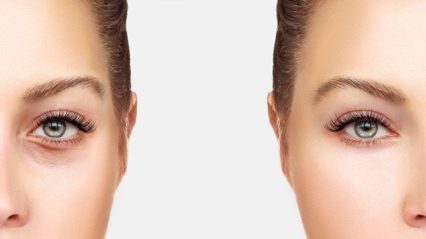 Home recovery after blepharoplasty
