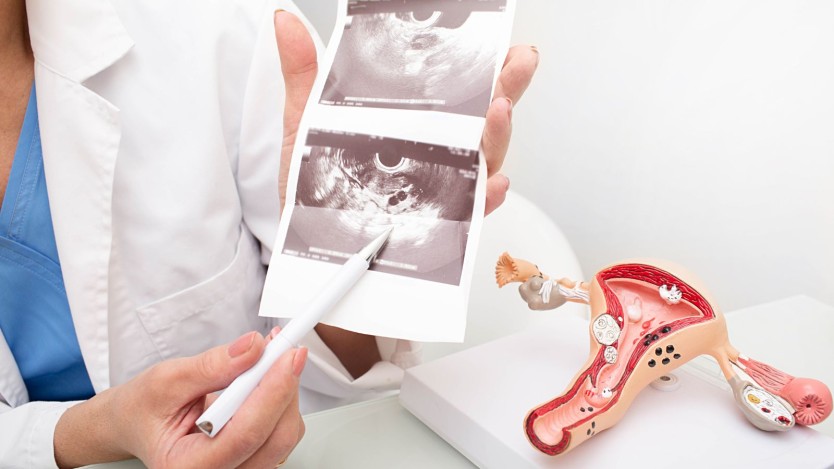 What is a hysterectomy