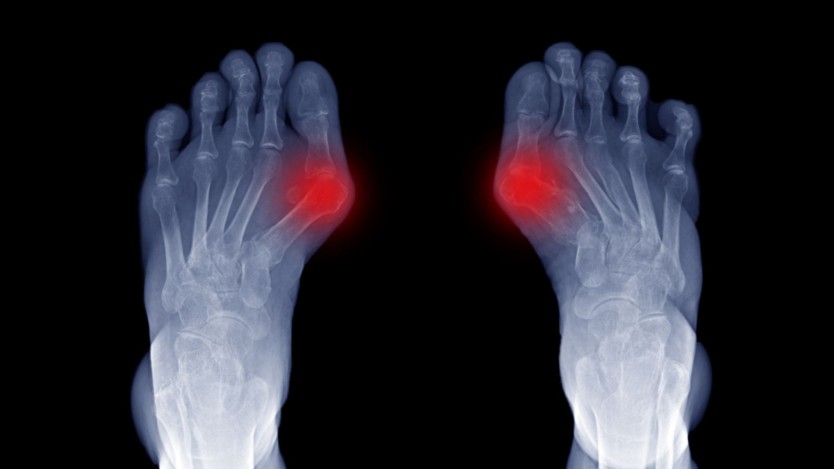 Bunions and hammertoes