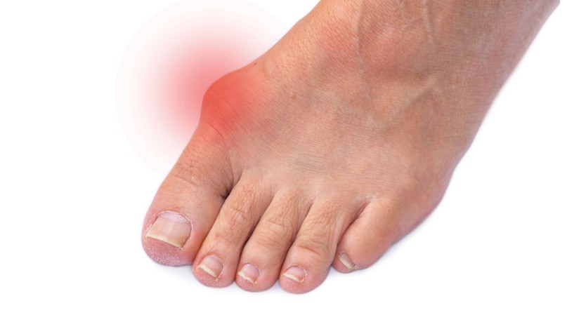Bunion Surgery