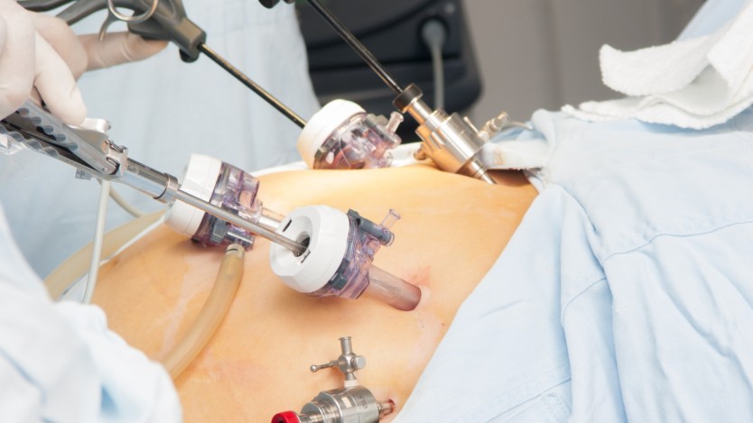 Hiatal hernia surgery