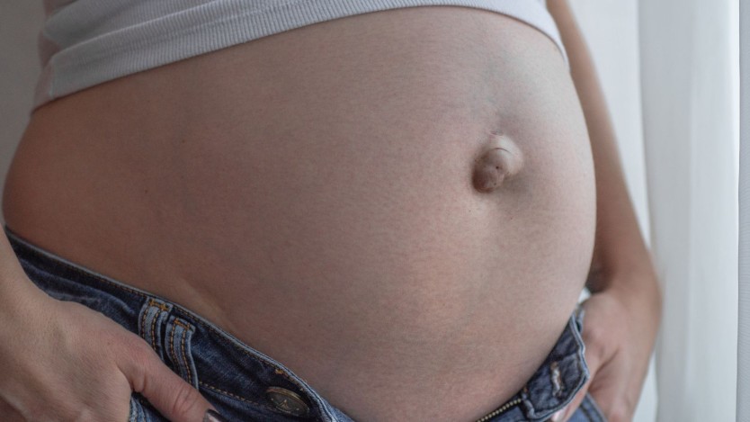 Umbilical hernias in pregnant women
