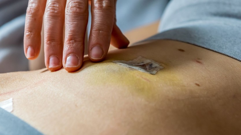 Surgeries performed with laparoscopy