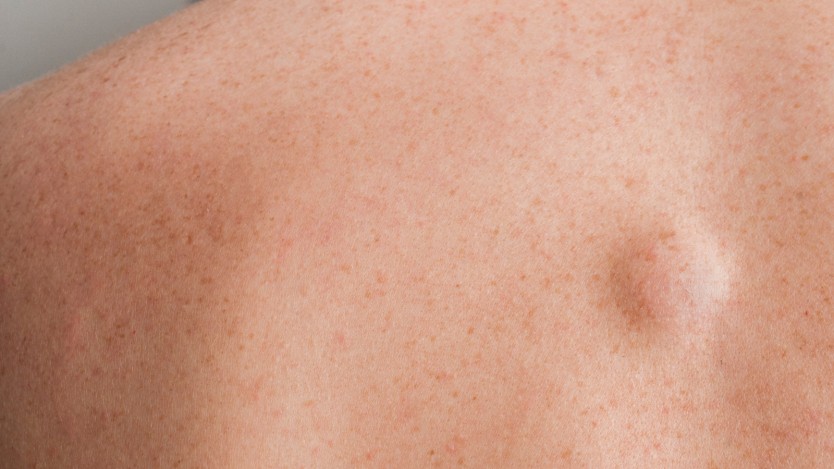 Sebaceous cyst