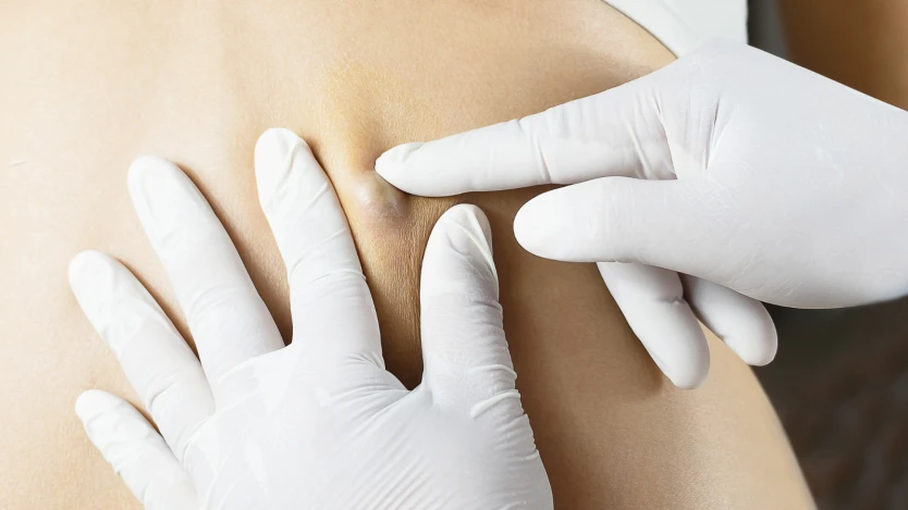 Sebaceous cysts in the scalp