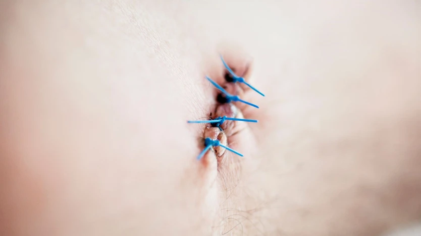 Suture for a sebaceous cyst