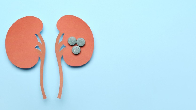 Holmium laser lithotripsy surgery for the treatment of kidney stones
