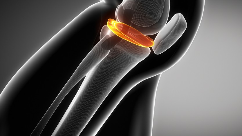 Lateral torn meniscus 