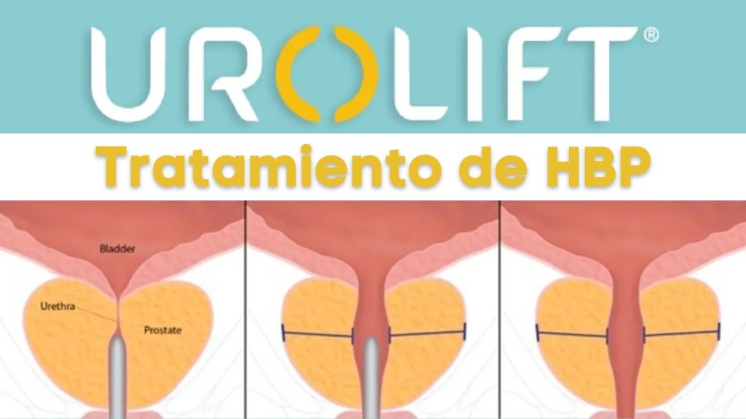 Urolift prostate surgery