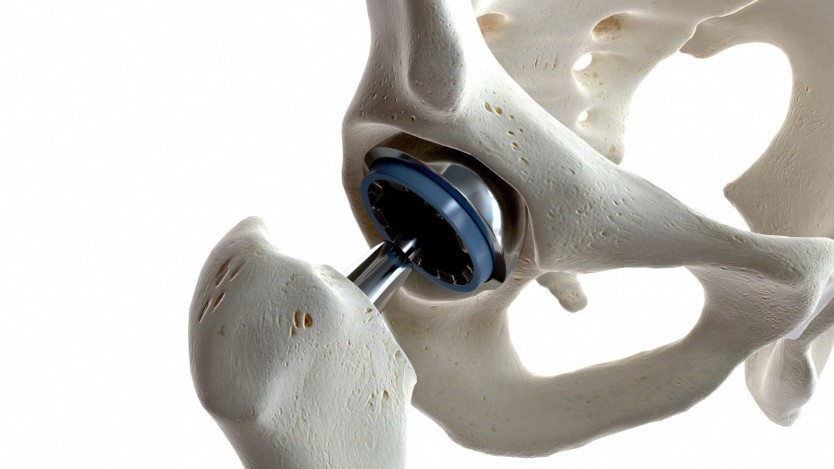 Types of hip prosthesis