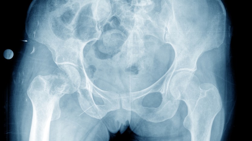 Hip prosthesis