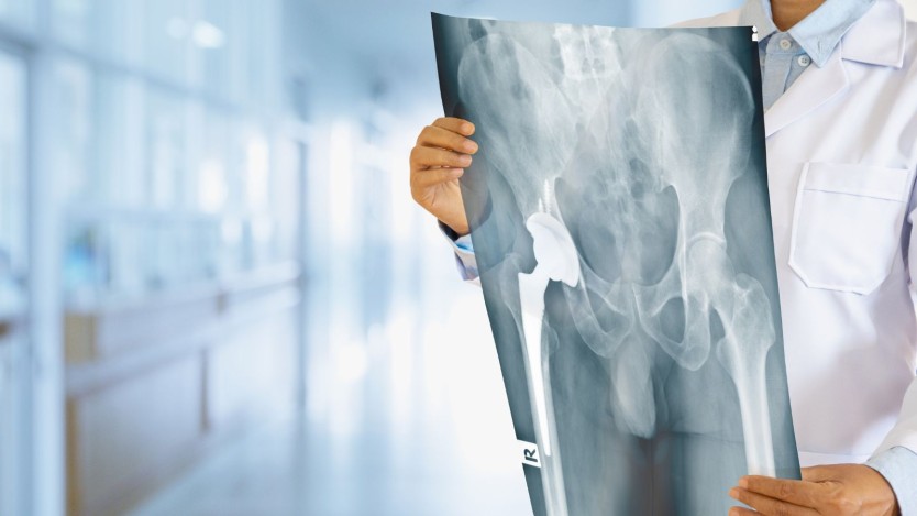 Total Hip replacement surgery