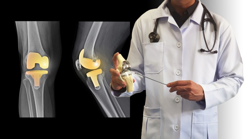 Knee replacement