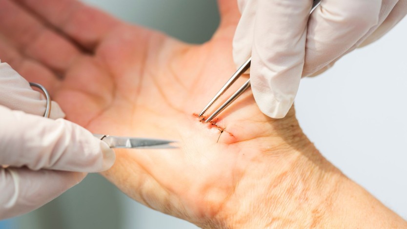 Non-surgical treatment for carpal tunnel