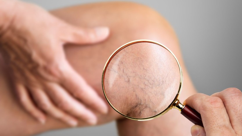 Diagnosis of varicose veins